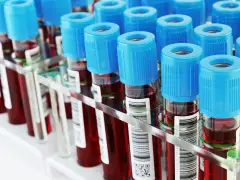 First-of-its-kind Alzheimer's blood test made by Malvern company gets FDA clearance